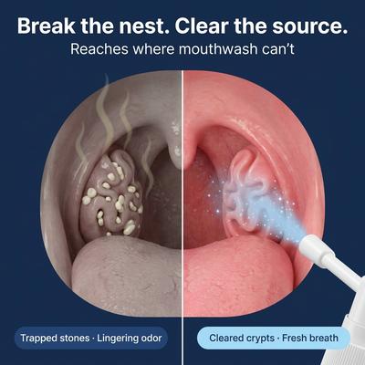 Tonsil Stone Cleaner - Deep Clean & Protective Barrier